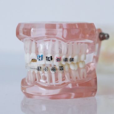 Everything you need to know about getting braces in Spokane, WA￼