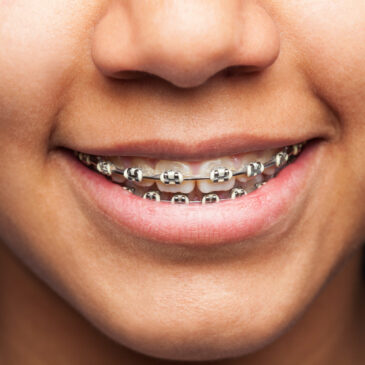 The Many Health Benefits of Wearing Braces