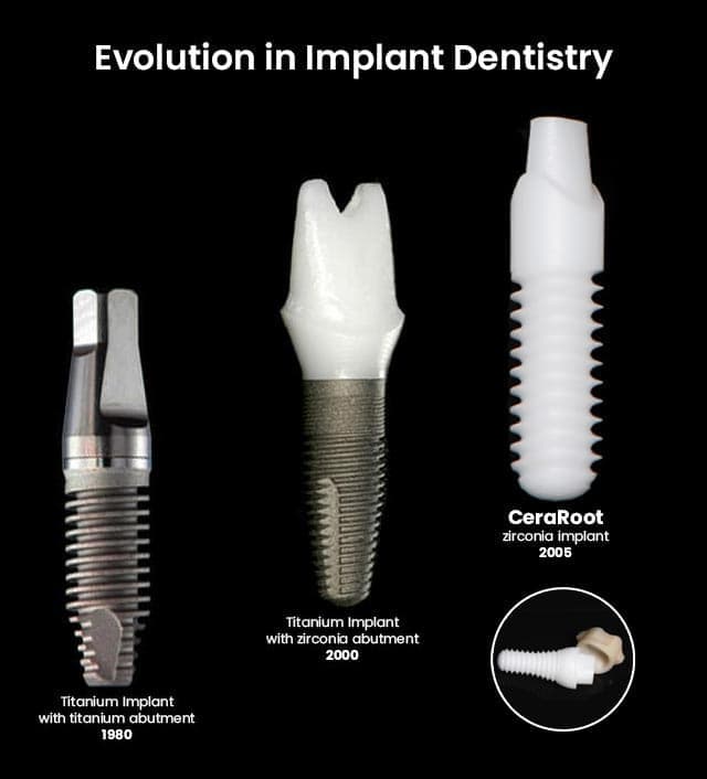 non metal dental implants        
        <figure class=